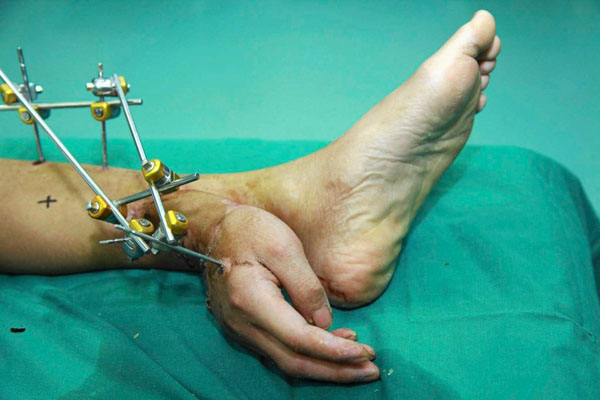 Cirujanos injertan la mano de un hombre en su pierna