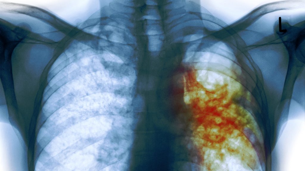 Convocan a caminata por Día Mundial contra la Tuberculosis en Pto. Vallarta