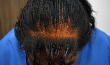 Hasta el dos por ciento de los mexicanos enfrenta pérdida de cabello