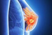 Un estudio concluye que un tipo cáncer mama se podría curar sin quimioterapia