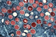 Suecia reporta 1er caso de forma más infecciosa de viruela símica, identificada primero en el Congo