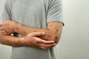 Confirman cuatro casos importados de Mpox en Vallarta